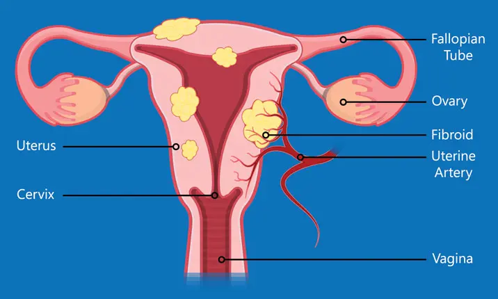 Myomectomy picture