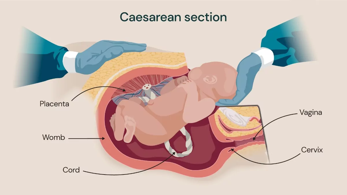 Caesarian Section (C/s) picture