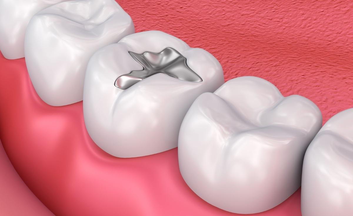 Tooth Filling picture